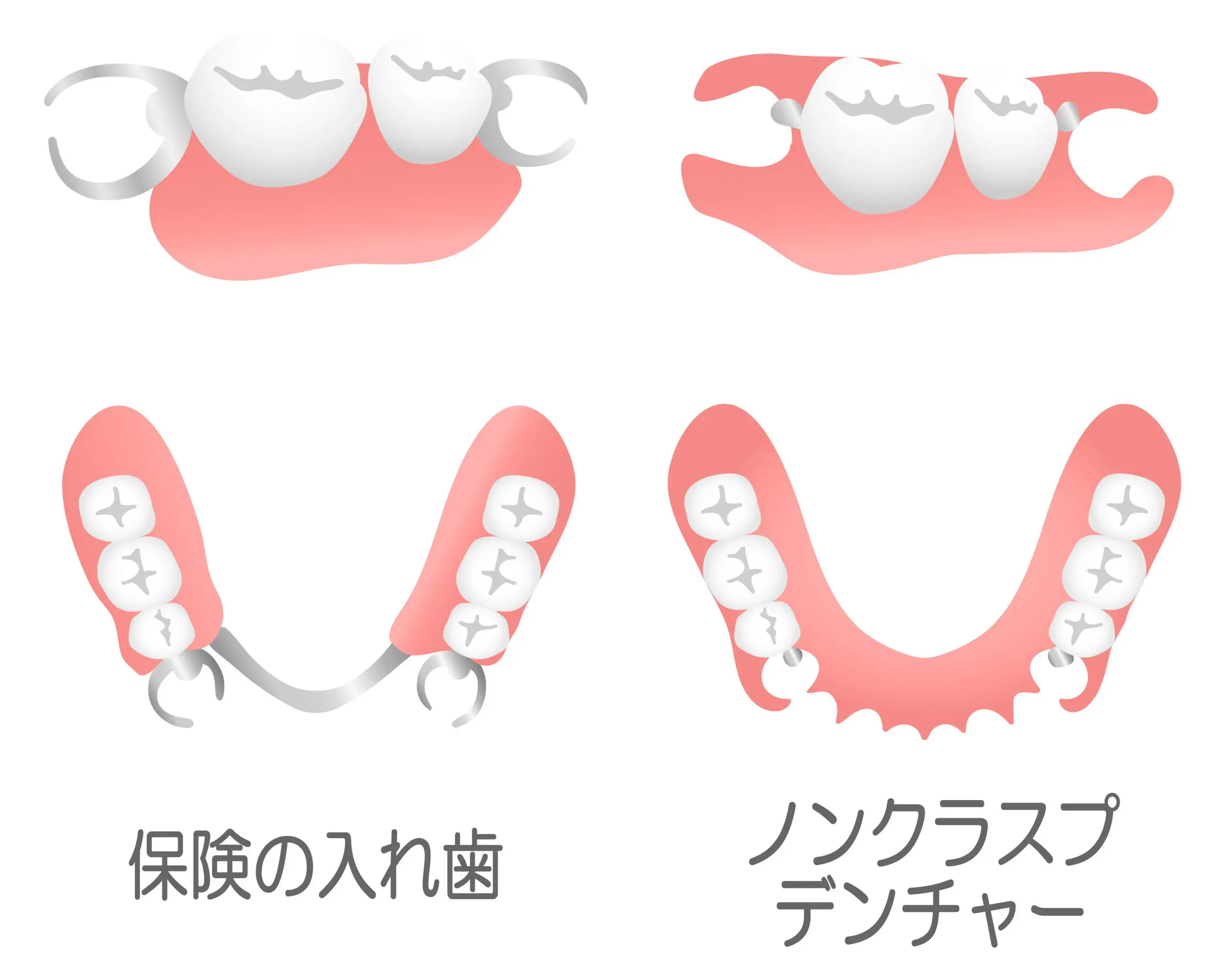 次世代の入れ歯「ノンクラスプデンチャー」の価格と選び方を徹底解説!1本あたり20万円以上の相場 | 札幌 歯周病・予防歯科